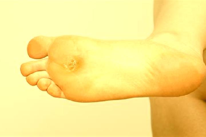 escort Callus